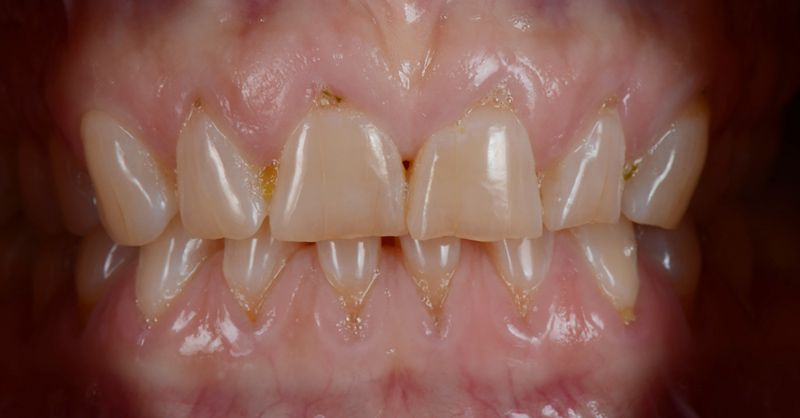 Norris Dental Patient Before Treatments